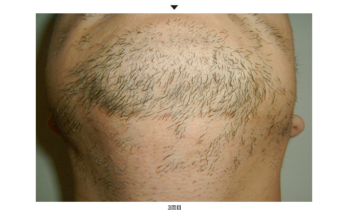 ひげ脱毛の症例写真