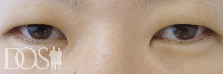 当院患者様（35歳）：二重形成、目の幅拡大、厚いまぶたの改善