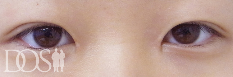 当院患者様（19歳）：目の幅拡大、二重の幅変更