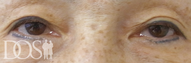 当院患者様（63歳）：眼瞼下垂