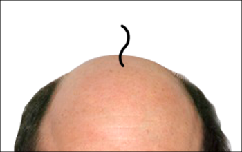 AGAの初期症状は抜け毛が増えるとともに髪が細くなっていきます。