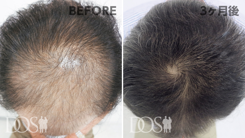 薄毛治療3ヵ月行った男性の発毛症例。