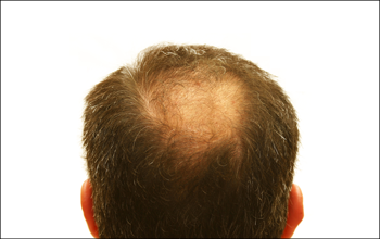 抜け毛や薄毛は遺伝子も関係しています。