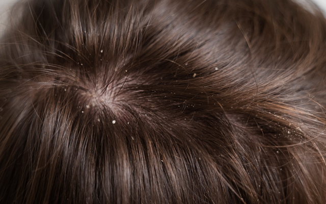 薄毛の原因の一つに頭皮の乾燥があります。