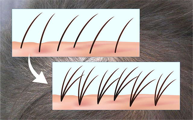 AGAクリニック広島の人工植毛は即効性のあるAGA治療です。