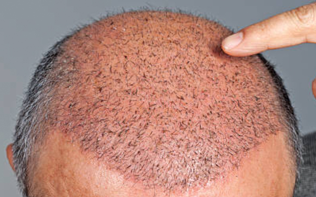 自毛植毛は広島のAGAクリニックで治療できます。