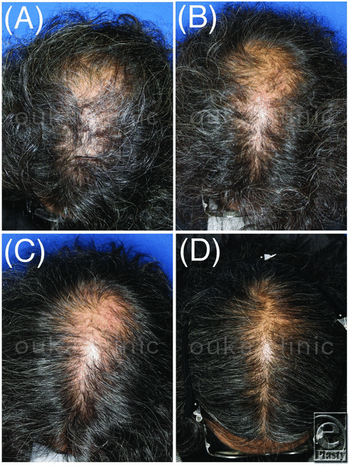 薄毛治療をした47歳男性の治療前から治療後までの写真。