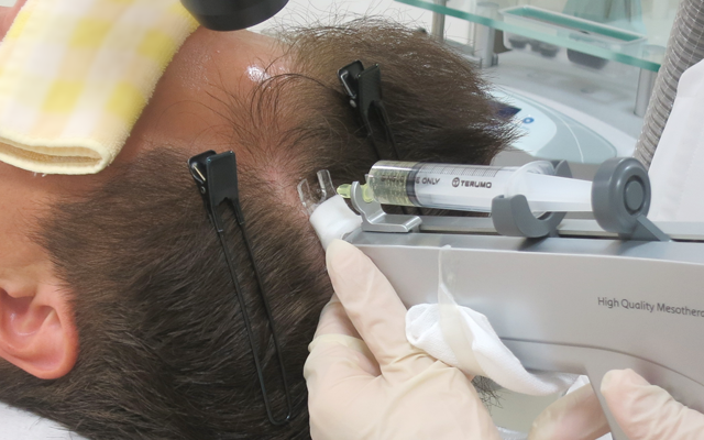 AGA治療である発毛カクテル注射は有効成分を直接頭皮に注入する方法で効果が期待できます。