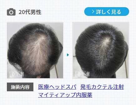 20代男性のAGA治療の発毛症例。