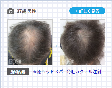 薄毛に効果的な発毛カクテル注射の37歳男性の症例。
