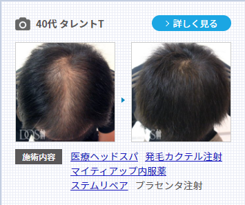 発毛治療で効果が出た40代男性の症例。