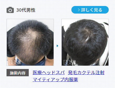 AGA治療薬のマイティアップ内服薬を服用した発毛症例。