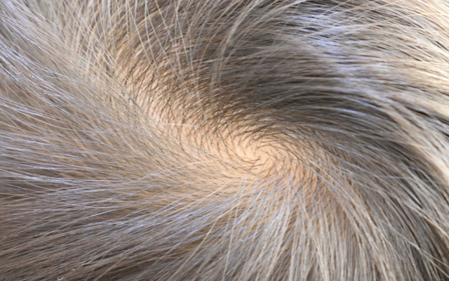 薄毛の原因は白髪を抜くことで毛穴が縮小することにあります。