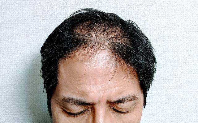 薄毛や抜け毛は加齢や老化によっても発症しますが、漢方薬で改善できます。