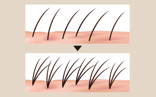 人工植毛も自毛植毛と同じく効果が早くでます。