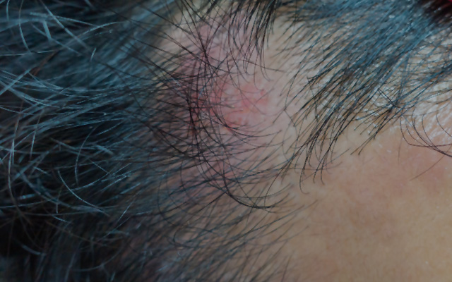 薄毛はパーマ液で頭皮環境が悪化することで起こります。