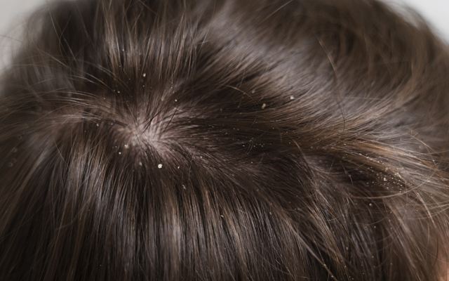 薄毛、抜け毛対策に必要な育毛剤は頭皮ケア成分が含まれているものを選ぶことが大切です。