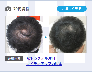 薄毛治療でHARG療法を行った20代男性の症例写真。