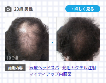 育毛促進効果のあるミノキシジルを含む発毛症例写真。
