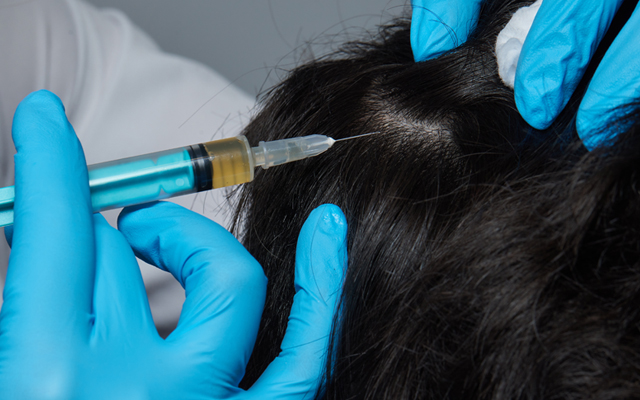 発毛効果や抜け毛を抑制する効果のある発毛カクテル注射