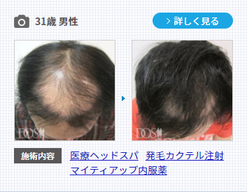 発毛治療を6ヶ月行った30代男性の症例写真。