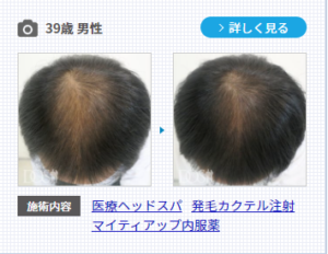 AGA治療の発毛カクテル注射を含む治療の症例
