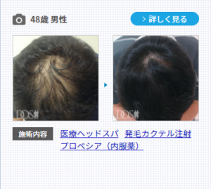 薄毛効果のある発毛カクテル注射の症例写真