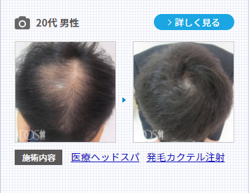 AGA治療である発毛カクテル注射を使用した男性の症例。