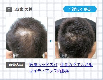 AGAクリニックで薄毛治療を行った33歳男性の症例写真。