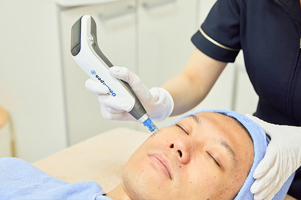 ダーマペンを使用したスキンケアの美容の施術を受ける患者