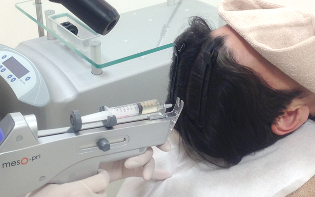 薄毛対策にはカクテル注射で頭皮に直接有効成分を注入することが効果的です。