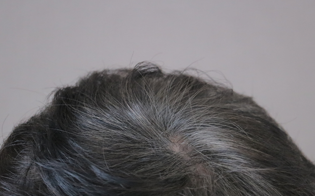 薄毛の初期症状の1つは髪にハリやコシがないことです。