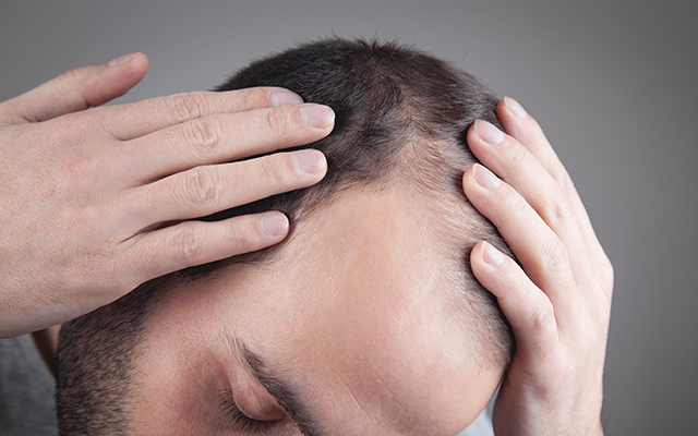 薄毛が進行している場合はおでこが後退しています。