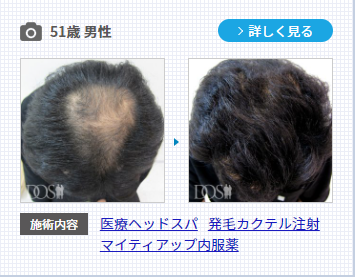 ミノキシジルを含むAGA治療の50代男性の症例。