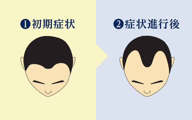 薄毛の初期段階で治療を行うと費用も抑えられ治療期間も短縮できます。