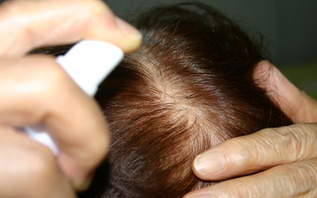 育毛シャンプーや育毛剤はボリュームやハリを目的にしてるため改善は難しい。