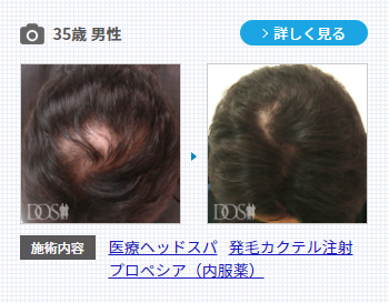 AGA治療薬プロペシアを服用すると効果が出るまでに3～6ヶ月かかります。