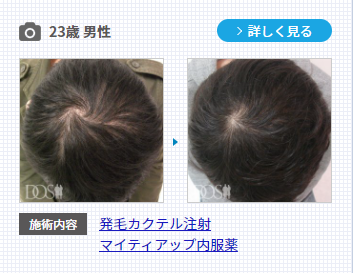 20代男性の発毛治療の症例写真