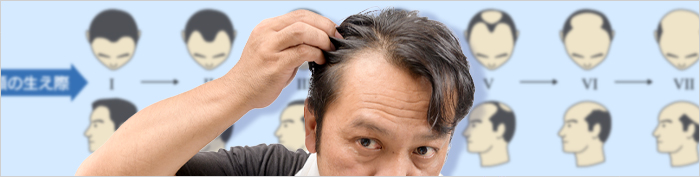 薄毛の種類と特徴を解説し、対策法をご紹介します。