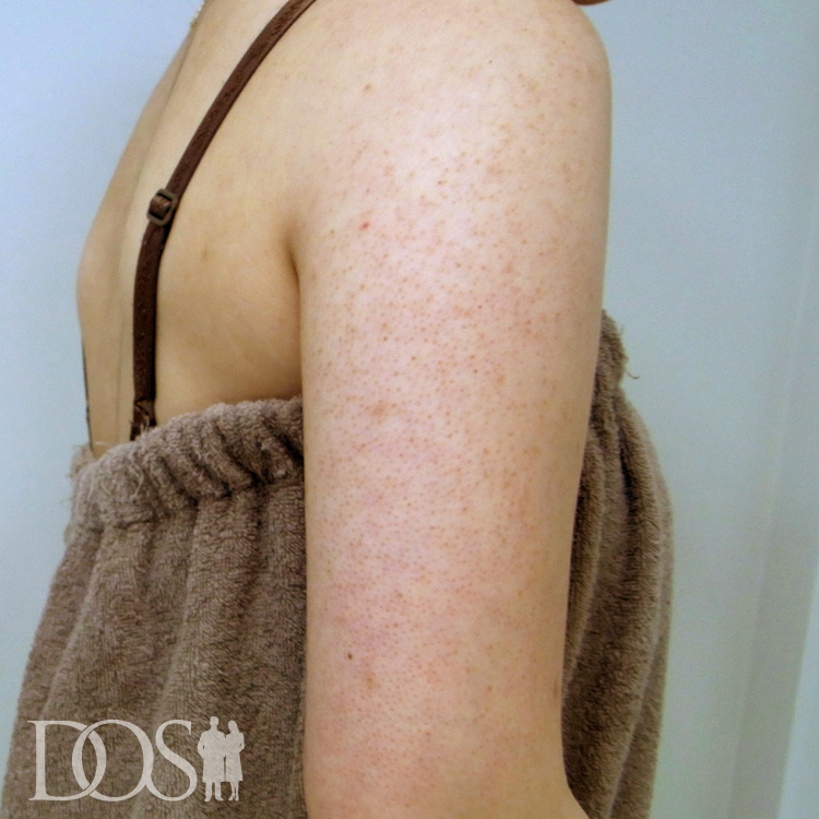 【未使用】三愛クリーム5個セット　毛孔性苔癬治療用 当院患者さま（24歳）：毛孔性苔癬 | AGA治療専門「男たちの美容外科