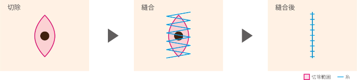 切除縫縮法についての説明図