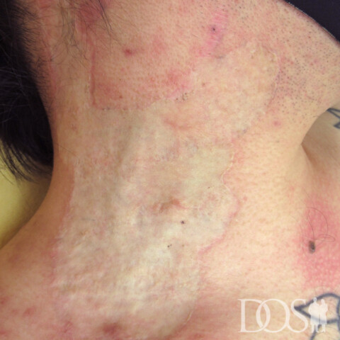 当院患者さま：首のタトゥー：施術後