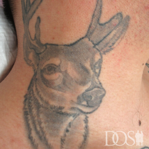 当院患者さま：首のタトゥー：施術前